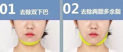 臉部吸脂手術(shù)注意事項(xiàng)