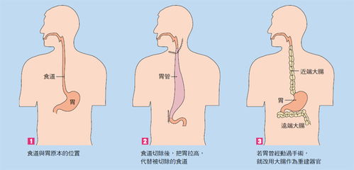 食道隆起esd手術(shù)后注意事項(xiàng)
