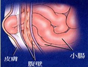 疝氣手術(shù)的注意事項(xiàng)