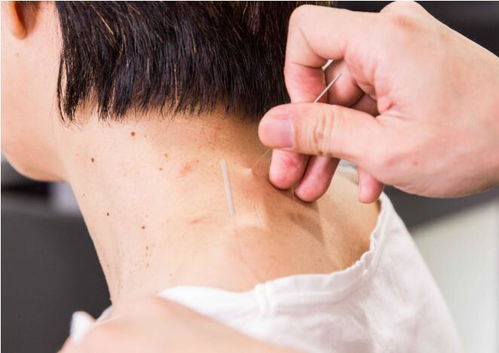 頸椎,注意事項,埋針后