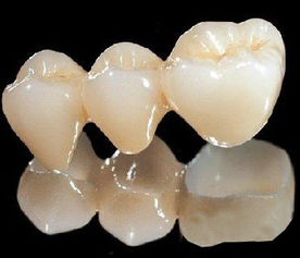 烤瓷牙修復(fù)注意事項(xiàng)