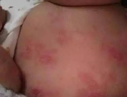 寶寶起疹子注意事項