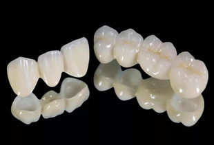 剛做完烤瓷牙需要注意什么,烤瓷牙鑲牙后注意事項(xiàng),安裝烤瓷牙后注意事項(xiàng)