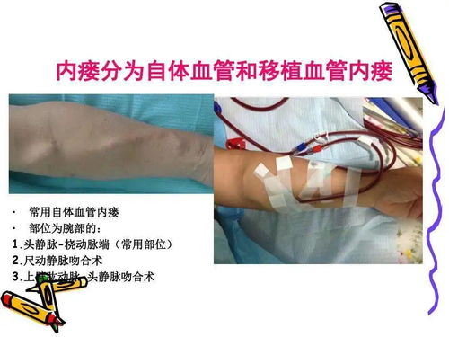 動靜脈瘺護(hù)理注意事項