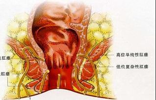 肛瘺術(shù)后上班注意事項(xiàng)