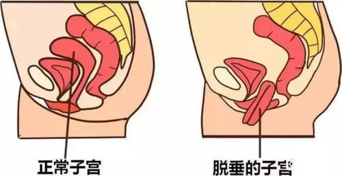 術(shù)后,修補(bǔ),子宮,注意事項(xiàng)