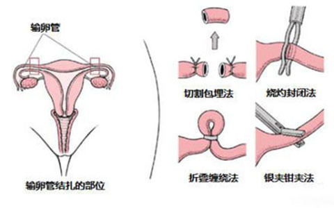 結(jié)扎復(fù)通術(shù)后要注意什么,輸精管結(jié)扎術(shù)后注意事項,精索靜脈曲張結(jié)扎術(shù)后注意事項