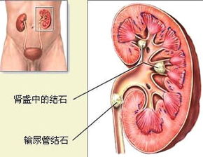 腎結石注意事項及飲食禁忌,腎結石日常生活注意事項,腎結石術后注意事項
