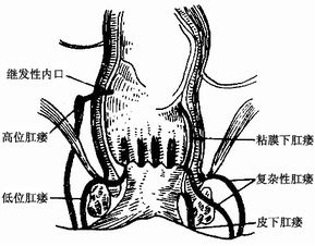 肛瘺內(nèi)瘺的護(hù)理及注意事項(xiàng)