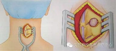 駝背手術需要注意事項