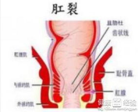 流血,注意事項(xiàng),肛裂