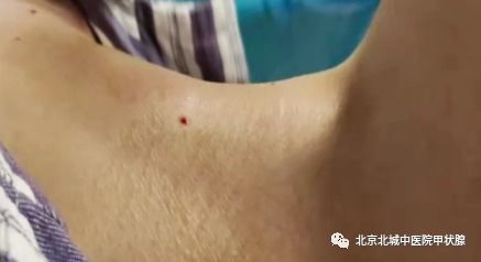 消融術(shù)后飲食注意事項