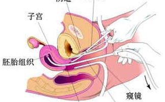 微創(chuàng)人流后注意事項(xiàng)和調(diào)理,無痛人流后注意事項(xiàng),微創(chuàng)人流手術(shù)后注意事項(xiàng)