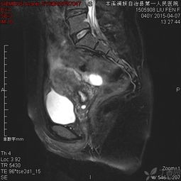 mri增強(qiáng)檢查注意事項(xiàng)