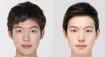 長(zhǎng)春短鼻矯正術(shù)的相關(guān)注意事項(xiàng)