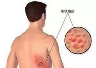 帶狀皰疹的注意事項(xiàng),帶狀皰疹注意事項(xiàng)和飲食,帶狀皰疹疫苗接種注意事項(xiàng)