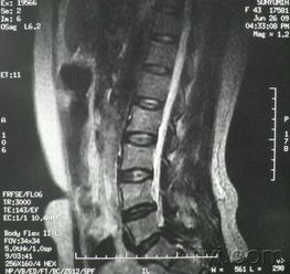 神經(jīng)根受損后注意事項(xiàng)