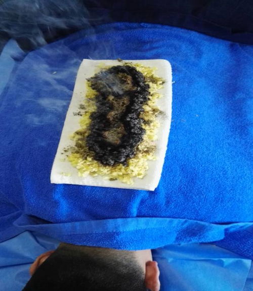 注意事項(xiàng),長蛇灸