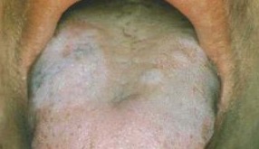 注意事項扁平苔蘚