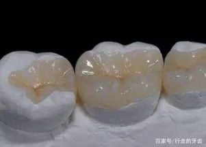 嵌體補牙后注意事項,瓷嵌體補牙后注意事項,補牙后的注意事項