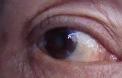 輕微白內(nèi)障注意事項