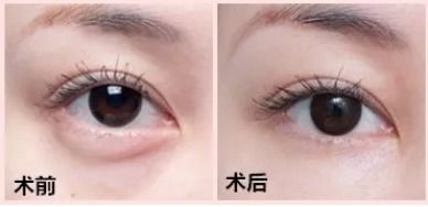 做了內(nèi)切眼袋注意事項
