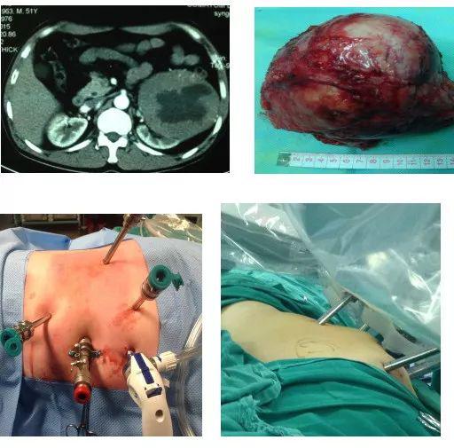 腎癌,術(shù)前,注意事項(xiàng)