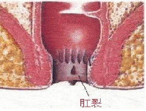 肛裂流血注意事項(xiàng)