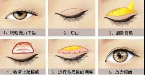換眼睛手術后注意事項