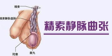 精索靜脈曲張手術后要注意什么,精索鞘膜積液手術后注意事項,精索手術術后注意事項