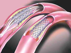 支架術(shù)前術(shù)后注意事項(xiàng),冠脈支架術(shù)后的注意事項(xiàng),冠脈支架植入術(shù)后注意事項(xiàng)