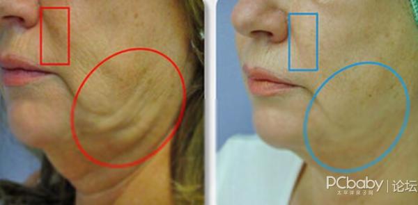 埋線之后注意事項