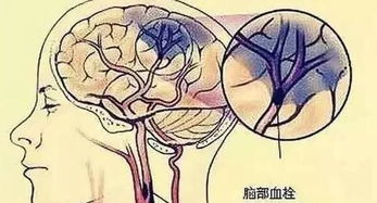 腦血栓溶栓后注意事項(xiàng),腦血栓出院后注意事項(xiàng),腦血栓的注意事項(xiàng)