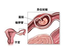宮外孕,手術后,注意事項
