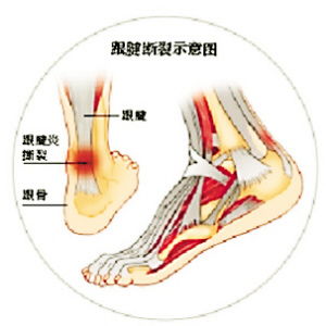 跟腱,康復(fù),注意事項