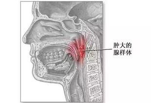 小兒腺樣體肥大的基礎(chǔ)知識(shí)
