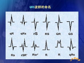 心電圖,基礎(chǔ)知識,護理,教學(xué)